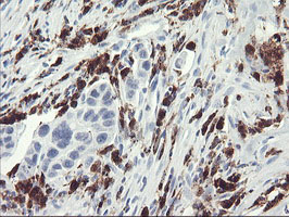 SDS Antibody - IHC of paraffin-embedded Carcinoma of Human lung tissue using anti-SDS mouse monoclonal antibody.