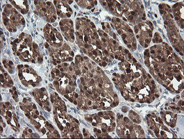 SDSL / Serine Dehydratase-Like Antibody - IHC of paraffin-embedded Carcinoma of Human thyroid tissue using anti-SDSL mouse monoclonal antibody. (Heat-induced epitope retrieval by 10mM citric buffer, pH6.0, 100C for 10min).