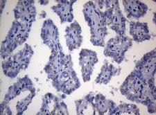 SEC14L1 Antibody - Immunohistochemical staining of paraffin-embedded Carcinoma of Human thyroid tissue using anti-SEC14L1 mouse monoclonal antibody. (Heat-induced epitope retrieval by 1mM EDTA in 10mM Tris buffer. (pH8.5) at 120°C for 3 min. (1:150)