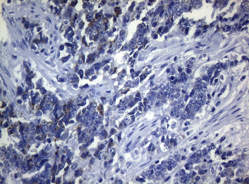 SEC14L1 Antibody - Immunohistochemical staining of paraffin-embedded Adenocarcinoma of Human endometrium tissue using anti-SEC14L1 mouse monoclonal antibody. (Heat-induced epitope retrieval by 1mM EDTA in 10mM Tris buffer. (pH8.5) at 120°C for 3 min. (1:150)