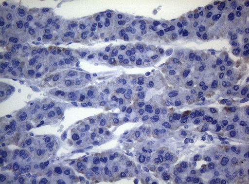 SEC14L1 Antibody - Immunohistochemical staining of paraffin-embedded Carcinoma of Human liver tissue using anti-SEC14L1 mouse monoclonal antibody. (Heat-induced epitope retrieval by 1mM EDTA in 10mM Tris buffer. (pH8.5) at 120°C for 3 min. (1:150)