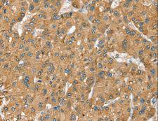 SEC14L2 Antibody - Immunohistochemistry of paraffin-embedded Human liver cancer using SEC14L2 Polyclonal Antibody at dilution of 1:40.