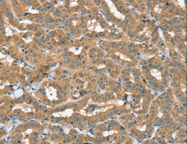 SEC14L2 Antibody - Immunohistochemistry of paraffin-embedded Human thyroid cancer using SEC14L2 Polyclonal Antibody at dilution of 1:40.