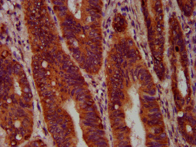 SEC14L2 Antibody - Immunohistochemistry Dilution at 1:400 and staining in paraffin-embedded human colon cancer performed on a Leica BondTM system. After dewaxing and hydration, antigen retrieval was mediated by high pressure in a citrate buffer (pH 6.0). Section was blocked with 10% normal Goat serum 30min at RT. Then primary antibody (1% BSA) was incubated at 4°C overnight. The primary is detected by a biotinylated Secondary antibody and visualized using an HRP conjugated SP system.
