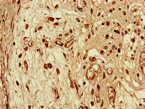 SEC14L3 Antibody - Immunohistochemistry of paraffin-embedded human lung cancer using SEC14L3 Antibody at dilution of 1:100