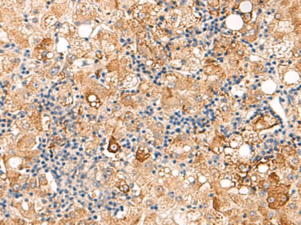 SEC22B Antibody - Immunohistochemistry of paraffin-embedded Human liver cancer tissue  using SEC22B Polyclonal Antibody at dilution of 1:70(×200)