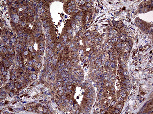 SEC23B Antibody - Immunohistochemical staining of paraffin-embedded Adenocarcinoma of Human colon tissue using anti-SEC23B mouse monoclonal antibody. (Heat-induced epitope retrieval by 1mM EDTA in 10mM Tris buffer. (pH8.5) at 120°C for 3 min. (1:2000)