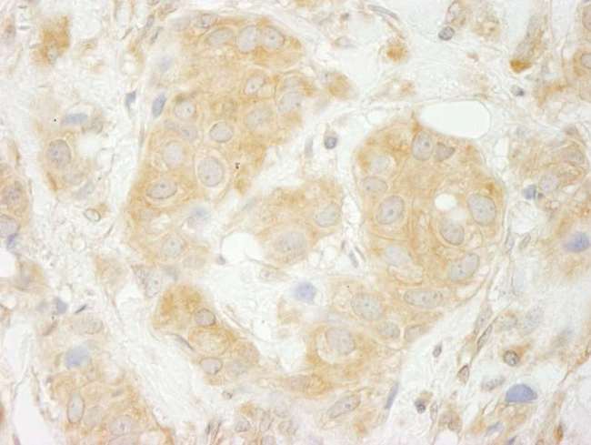 SEC23IP / p125 Antibody - Detection of Human Sec23IP(MSTP053) by Immunohistochemistry. Sample: FFPE section of human breast carcinoma. Antibody: Affinity purified rabbit anti- Sec23IP(MSTP053) used at a dilution of 1:200 (1 Detection: DAB.