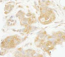 SEC23IP / p125 Antibody - Detection of Human Sec23IP/MSTP053 by Immunohistochemistry. Sample: FFPE section of human breast carcinoma. Antibody: Affinity purified rabbit anti-Sec23IP/MSTP053 used at a dilution of 1:250. Epitope Retrieval Buffer-High pH (IHC-101J) was substituted for Epitope Retrieval Buffer-Reduced pH.