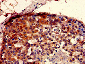 SEC23IP / p125 Antibody - Immunohistochemistry of paraffin-embedded human breast cancer using SEC23IP Antibody at dilution of 1:100