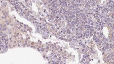 SEC24A Antibody - 1:100 staining human lymph carcinoma tissue by IHC-P. The sample was formaldehyde fixed and a heat mediated antigen retrieval step in citrate buffer was performed. The sample was then blocked and incubated with the antibody for 1.5 hours at 22°C. An HRP conjugated goat anti-rabbit antibody was used as the secondary.