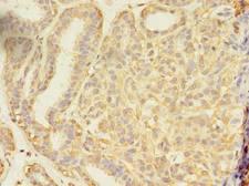 SEC31A / HSPC275 Antibody - Immunohistochemistry of paraffin-embedded human breast cancer using antibody at dilution of 1:100.