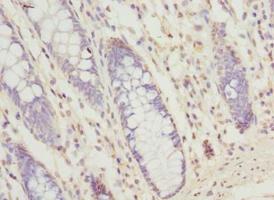 SEC61G Antibody - Immunohistochemistry of paraffin-embedded human colon cancer using antibody at dilution of 1:100.