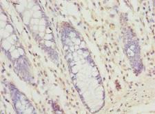 SEC61G Antibody - Immunohistochemistry of paraffin-embedded human colon cancer using antibody at dilution of 1:100.