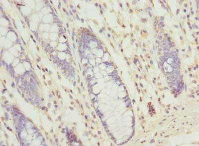 SEC61G Antibody - Immunohistochemistry of paraffin-embedded human colon cancer at dilution of 1:100