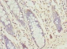 SEC61G Antibody - Immunohistochemistry of paraffin-embedded human colon cancer at dilution of 1:100