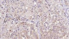 SEC63 Antibody - 1:100 staining human thyroid carcinoma tissue by IHC-P. The sample was formaldehyde fixed and a heat mediated antigen retrieval step in citrate buffer was performed. The sample was then blocked and incubated with the antibody for 1.5 hours at 22°C. An HRP conjugated goat anti-rabbit antibody was used as the secondary.