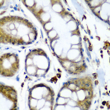 SECISBP2 / SBP2 Antibody - Immunohistochemistry of paraffin-embedded human colon carcinoma tissue.