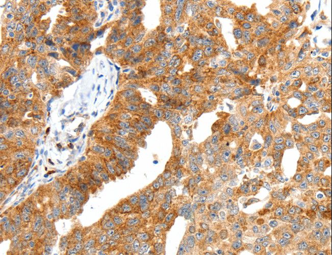 Secretin Antibody - Immunohistochemistry of paraffin-embedded Human ovarian cancer using SCT Polyclonal Antibody at dilution of 1:40.