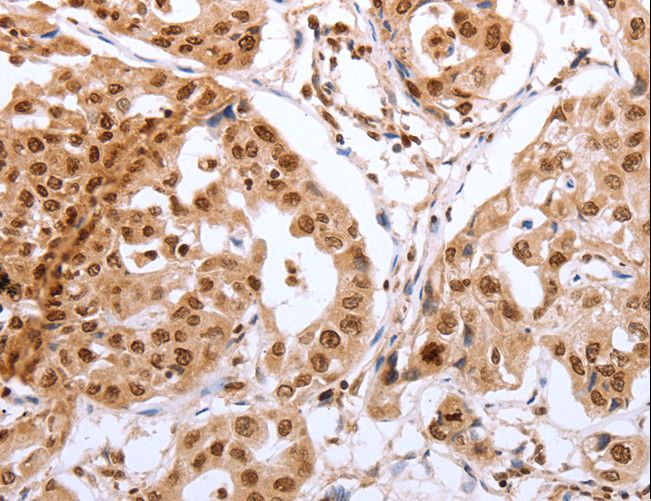 Securin / PTTG1 Antibody - Immunohistochemistry of paraffin-embedded Human lung cancer using PTTG1 Polyclonal Antibody at dilution of 1:60.