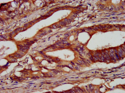 SEL1L Antibody - Immunohistochemistry image at a dilution of 1:100 and staining in paraffin-embedded human colon cancer performed on a Leica BondTM system. After dewaxing and hydration, antigen retrieval was mediated by high pressure in a citrate buffer (pH 6.0) . Section was blocked with 10% normal goat serum 30min at RT. Then primary antibody (1% BSA) was incubated at 4 °C overnight. The primary is detected by a biotinylated secondary antibody and visualized using an HRP conjugated SP system.