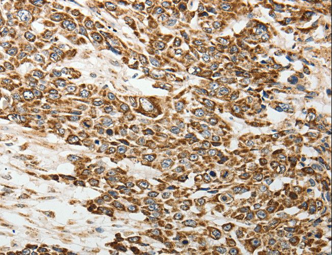 SELE / CD62E / E-selectin Antibody - Immunohistochemistry of paraffin-embedded Human lung cancer using SELE Polyclonal Antibody at dilution of 1:30.