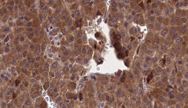 SELE / CD62E / E-selectin Antibody - 1:100 staining human liver carcinoma tissues by IHC-P. The sample was formaldehyde fixed and a heat mediated antigen retrieval step in citrate buffer was performed. The sample was then blocked and incubated with the antibody for 1.5 hours at 22°C. An HRP conjugated goat anti-rabbit antibody was used as the secondary.