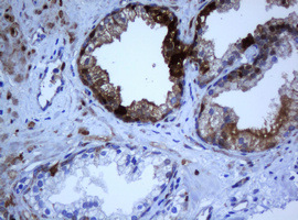 Selenium Binding Protein 1 Antibody - IHC of paraffin-embedded Carcinoma of Human prostate tissue using anti-SELENBP1 mouse monoclonal antibody.