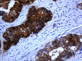 Selenium Binding Protein 1 Antibody - IHC of paraffin-embedded Adenocarcinoma of Human colon tissue using anti-SELENBP1 mouse monoclonal antibody.