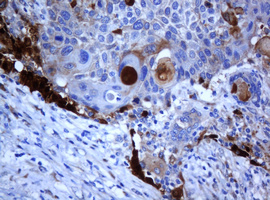 Selenium Binding Protein 1 Antibody - IHC of paraffin-embedded Carcinoma of Human lung tissue using anti-SELENBP1 mouse monoclonal antibody.