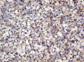 Selenium Binding Protein 1 Antibody - IHC of paraffin-embedded Carcinoma of Human kidney tissue using anti-SELENBP1 mouse monoclonal antibody.