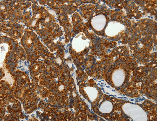 SELM / Selenoprotein M Antibody - Immunohistochemistry of paraffin-embedded Human thyroid cancer using SELM Polyclonal Antibody at dilution of 1:50.
