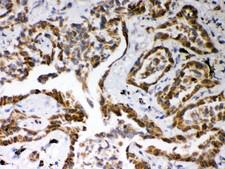 SELP / P-Selectin / CD62P Antibody - ABCG2 antibody, PB9364, IHC-paraffin: Human Lung Cancer Tissue.