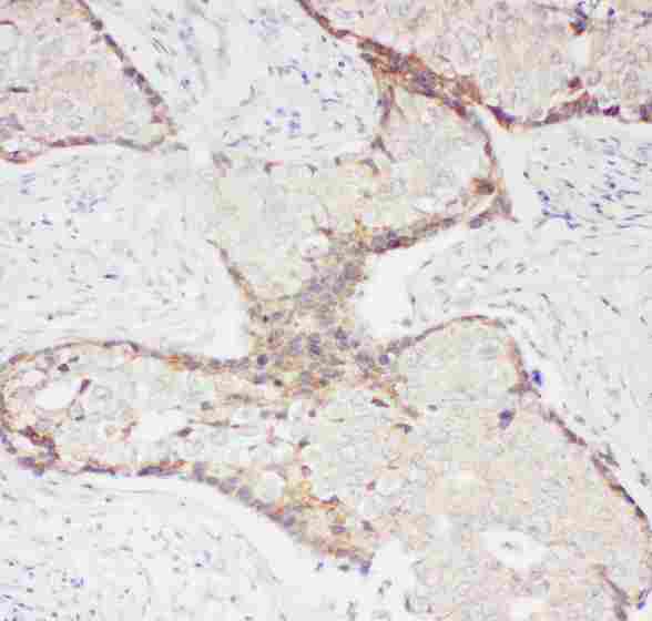 SELP / P-Selectin / CD62P Antibody - anti-CD62P antibody, IHC(P): Human Mammary Cancer Tissue