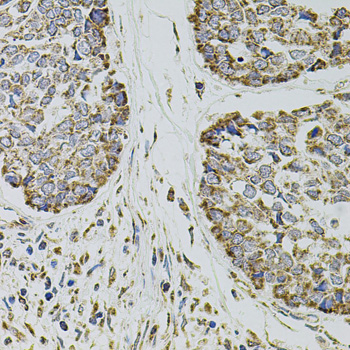 SELP / P-Selectin / CD62P Antibody - Immunohistochemistry of paraffin-embedded human esophageal cancer using SELP antibodyat dilution of 1:100 (40x lens).