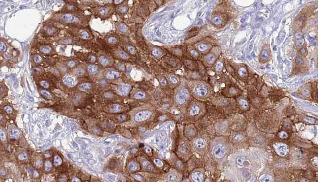 SELPLG / PSGL-1 / CD162 Antibody - 1:100 staining human Head and neck carcinoma tissue by IHC-P. The sample was formaldehyde fixed and a heat mediated antigen retrieval step in citrate buffer was performed. The sample was then blocked and incubated with the antibody for 1.5 hours at 22°C. An HRP conjugated goat anti-rabbit antibody was used as the secondary.