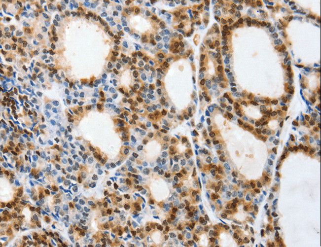 SELS Antibody - Immunohistochemistry of paraffin-embedded Human thyroid cancer using VIMP Polyclonal Antibody at dilution of 1:40.