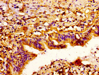 SEMA3A / Semaphorin 3A Antibody - Immunohistochemistry image at a dilution of 1:300 and staining in paraffin-embeddedhuman lung cancer performed on a Leica BondTM system. After dewaxing and hydration, antigen retrieval was mediated by high pressure in a citrate buffer (pH 6.0) . Section was blocked with 10% normal goat serum 30min at RT. Then primary antibody (1% BSA) was incubated at 4 °C overnight. The primary is detected by a biotinylated secondary antibody and visualized using an HRP conjugated ABC system.