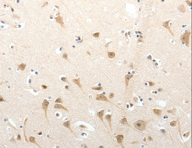 SEMA3D / Semaphorin 3D Antibody - Immunohistochemistry of paraffin-embedded Human cervical cancer using SEMA3D Polyclonal Antibody at dilution of 1:50.