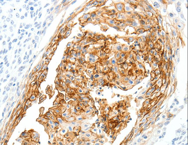 SEMA3D / Semaphorin 3D Antibody - Immunohistochemistry of paraffin-embedded Human cervical cancer using SEMA3D Polyclonal Antibody at dilution of 1:40.