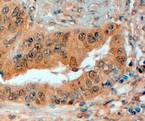 SEMA3E / Semaphorin 3E Antibody - Goat Anti-Semaphorin 3E (internal) Antibody (4µg/ml) staining of paraffin embedded Human Prostate. Steamed antigen retrieval with citrate buffer pH 6, HRP-staining.