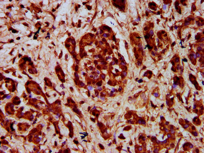 SEMA3F / Semaphorin 3F Antibody - Immunohistochemistry Dilution at 1:400 and staining in paraffin-embedded human pancreatic cancer performed on a Leica BondTM system. After dewaxing and hydration, antigen retrieval was mediated by high pressure in a citrate buffer (pH 6.0). Section was blocked with 10% normal Goat serum 30min at RT. Then primary antibody (1% BSA) was incubated at 4°C overnight. The primary is detected by a biotinylated Secondary antibody and visualized using an HRP conjugated SP system.