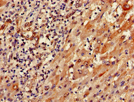 SEMA6A / Semaphorin 6A Antibody - Immunohistochemistry of paraffin-embedded human liver cancer using SEMA6A Antibody at dilution of 1:100