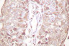 SENP1 Antibody - IHC of SENP1 (D2) pAb in paraffin-embedded human breast carcinoma tissue.