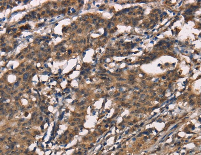 SENP1 Antibody - Immunohistochemistry of paraffin-embedded Human gastric cancer using SENP1 Polyclonal Antibody at dilution of 1:40.