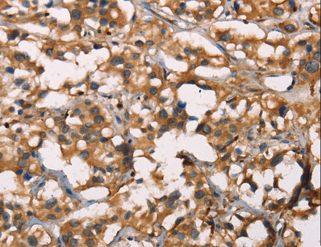 SENP1 Antibody - Immunohistochemistry of paraffin-embedded Human thyroid cancer using SENP1 Polyclonal Antibody at dilution of 1:40.