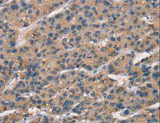 SENP1 Antibody - Immunohistochemistry of paraffin-embedded Human liver cancer using SENP1 Polyclonal Antibody at dilution of 1:25.