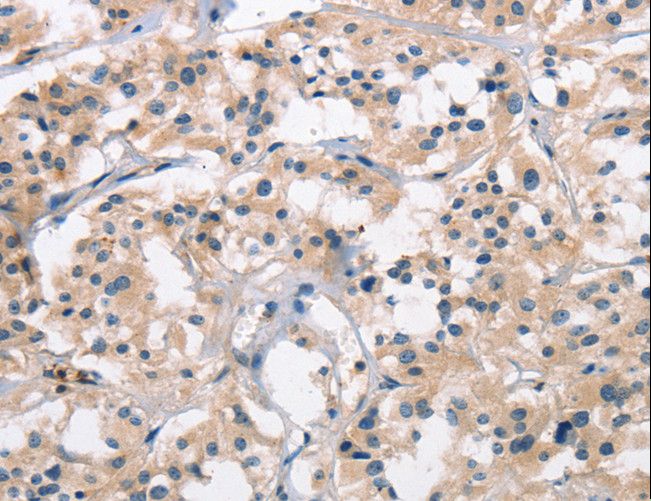 SENP1 Antibody - Immunohistochemistry of paraffin-embedded Human thyroid cancer using SENP1 Polyclonal Antibody at dilution of 1:25.