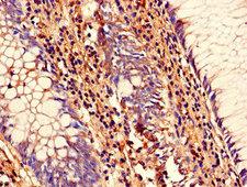 SENP1 Antibody - Immunohistochemistry of paraffin-embedded human colon cancer using SENP1 Antibody at dilution of 1:100