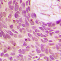 SENP1 Antibody - Immunohistochemical analysis of SENP1 staining in human breast cancer formalin fixed paraffin embedded tissue section. The section was pre-treated using heat mediated antigen retrieval with sodium citrate buffer (pH 6.0). The section was then incubated with the antibody at room temperature and detected using an HRP conjugated compact polymer system. DAB was used as the chromogen. The section was then counterstained with hematoxylin and mounted with DPX.